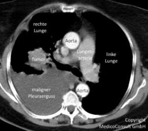 Querschnittsbild der Lungen - großer Tumor