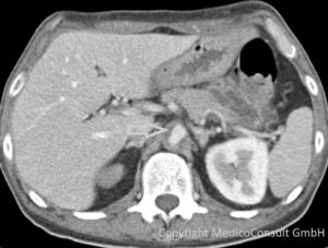 Aortendissektion im CT-Bild