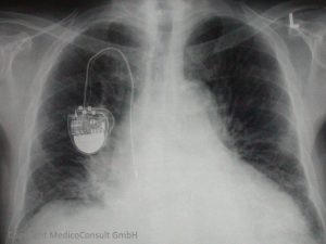 Herzvergrößerung, Schrittmacher, verkalkende Aortensklerose (Röntgenbild)