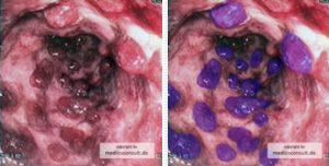 Colitis ulcerosa Chronischer Verlauf Pflastersteinrelief