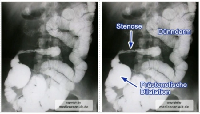 Diagnostik des Morbus Crohn - Facharztwissen