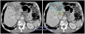 CT der Leber, Klatskin-Tumor mit segmentaler Cholestase