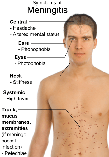 die behandlung der tuberkulosen meningitis bei erwachsenen