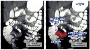Morbus Crohn MR-Sellink terminales Ileum