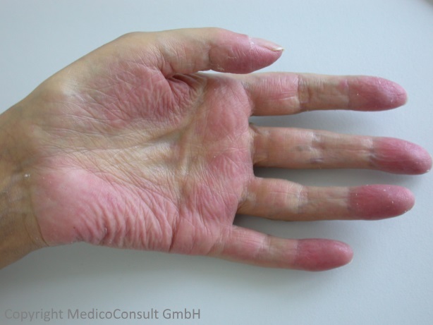 Rote Handflächen (Palmarerythem) als Zeichen einer Leberzirrhose.