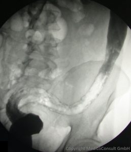 Colitis ulcerosa linksseitig starres Rohr Röntgen