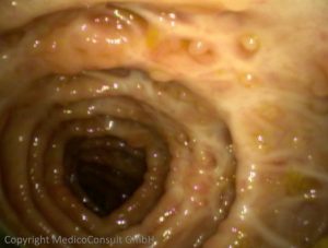Colitis ulcerosa Wandstarre Pseudopolypen Endoskopie
