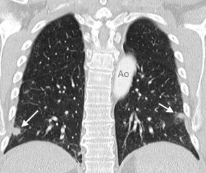 Lungenmetastasen eines Pankreaskarzinoms
