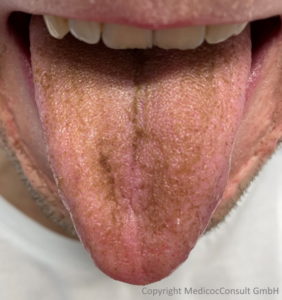 Dunkelbräunliche Verfärbung der Zungenoberfläche