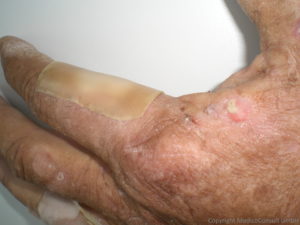 Hautläsionen bei Porphyria cutanea tarda
