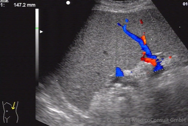 Sonographie der Milz - Facharztwissen