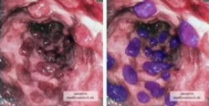 Colitis ulcerosa in Bildern - Facharztwissen
